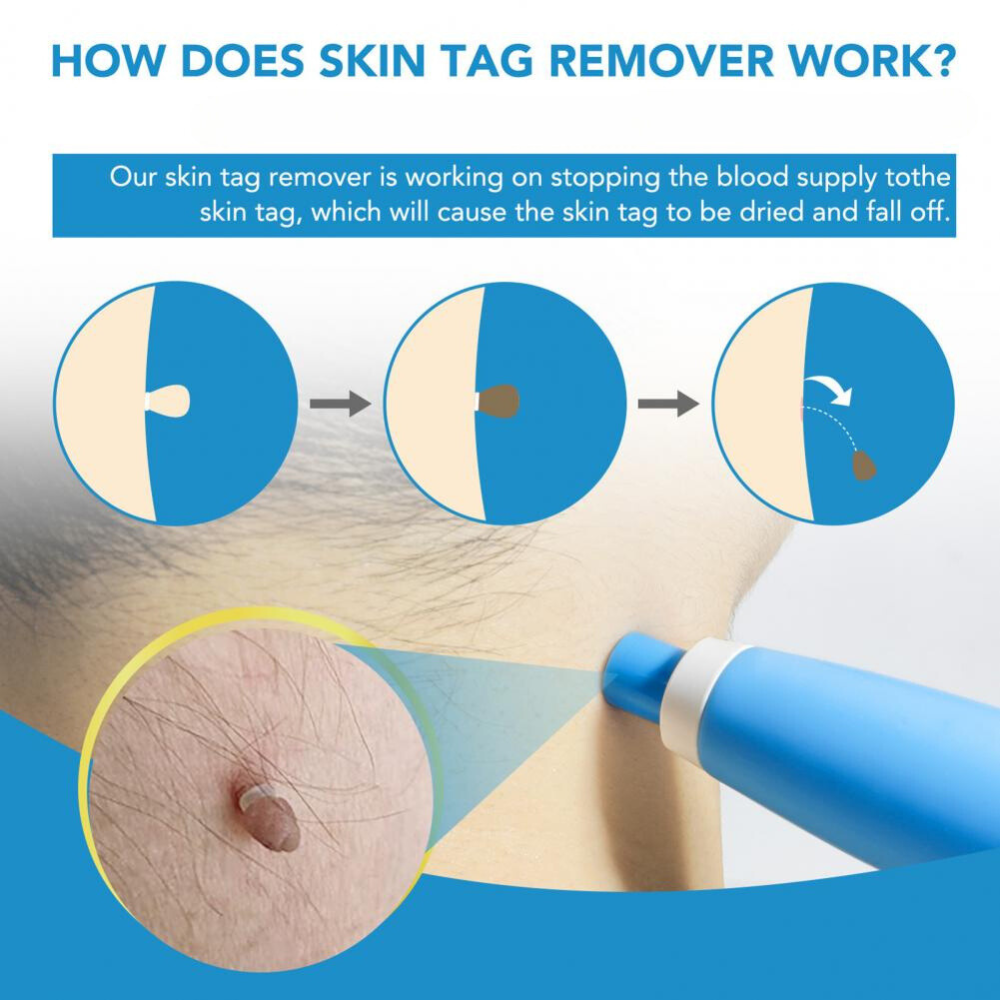 Auto Skin Tag Removal Kit